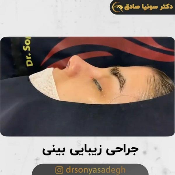 جراحی بینی - دکتر صادق