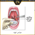 نکاتی درباره جراحی لوزه