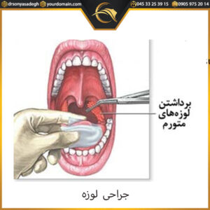 جراحی لوزه -دکتر سونیا صادق