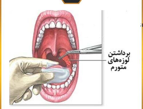 نکاتی درباره جراحی لوزه