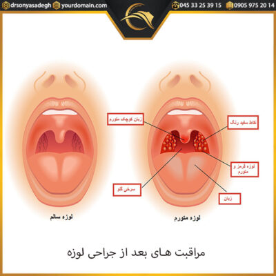 مراقبت های بعد از جراحی لوزه - دکتر صادق