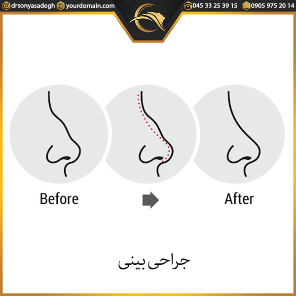 جراحی بینی در اردبیل - دکتر صادق