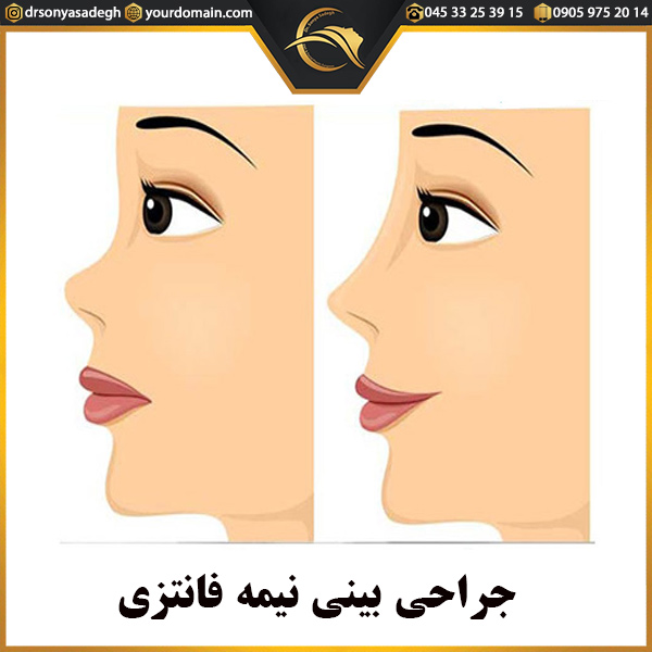 جراحی بینی نیمه فانتزی