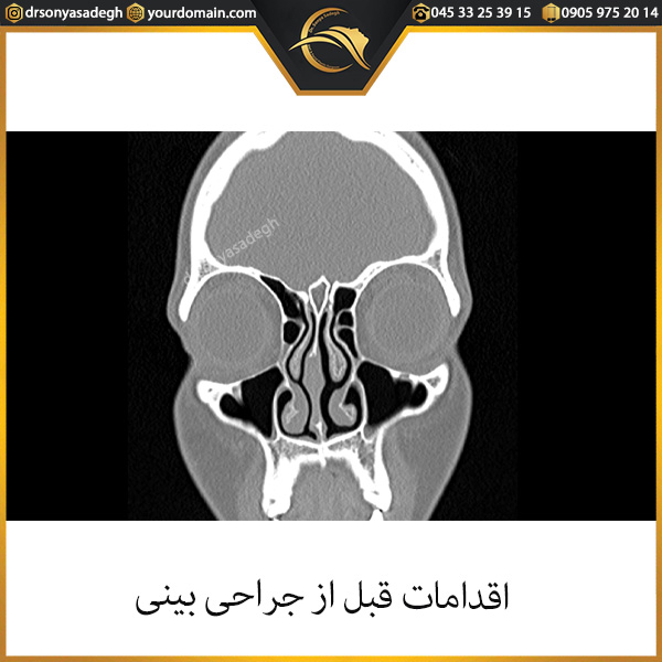 اقدامات قبل از جراحی بینی