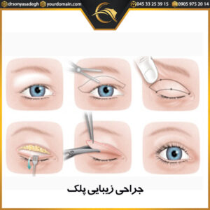 جراحی زیبایی پلک