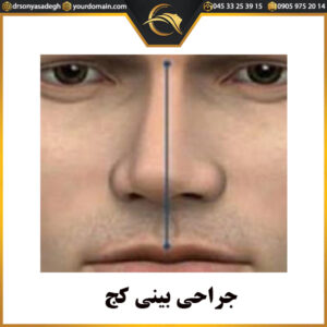 جراحی بینی کج - دکتر سونیا صادق