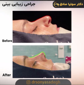جراحی بینی کج