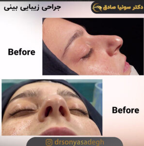 جراحی بینی کج