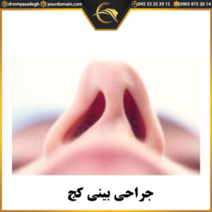 جراحی بینی کج - دکتر سونیا صادق