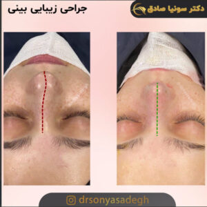 جراحی بینی کج