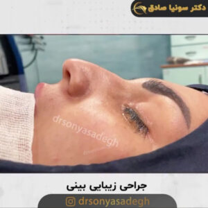 جراحی زیبایی بینی