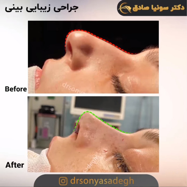 جراحی زیبایی بینی
