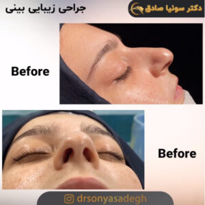 جراحی زیبایی بینی
