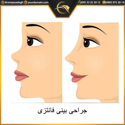 جراحی بینی فانتزی در اردبیل - دکتر صادق