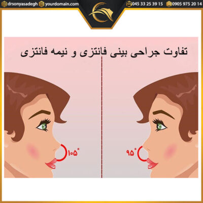 جراحی بینی فانتزی - دکتر صادق