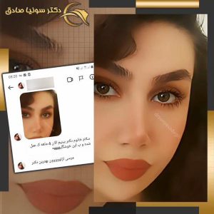 جراحی بینی - دکتر صادق