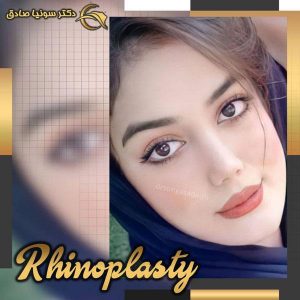 جراحی بینی - دکتر صادق