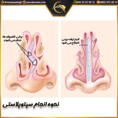 انحراف بینی _دکتر سونیا صادق