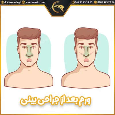 ورم بعد از جراحی بینی - دکتر صادق