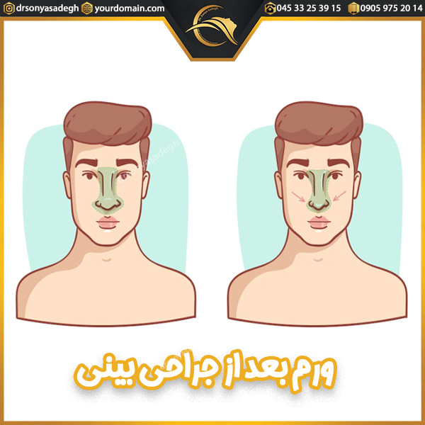 ورم بعد از جراحی بینی - دکتر صادق