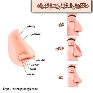 جراحی بینی استخوانی