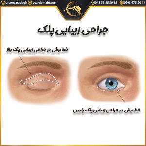 جراحی زیبایی پلک _دکتر سونیا صادق