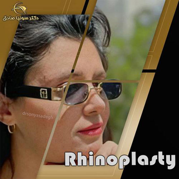جراحی بینی - دکتر سونیا صادق