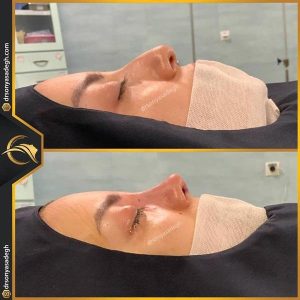 نمونه کار بهترین جراح بینی اردبیل | دکتر سونیا صادق