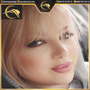 نمونه کار جراح بینی | دکتر سونیا صادق