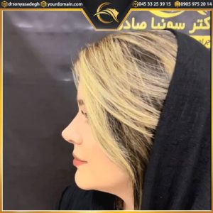 نمونه کار جراح بینی | دکتر سونیا صادق