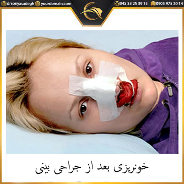 خونریزی بعد از جراحی بینی