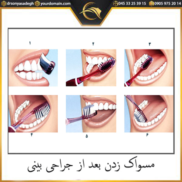 مسواک زدن بعد از جراحی بینی