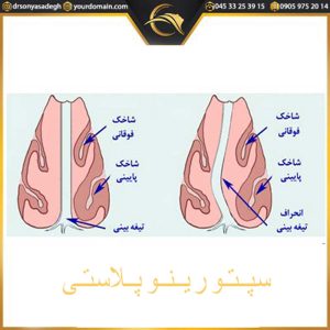 سپتورینوپلاستی