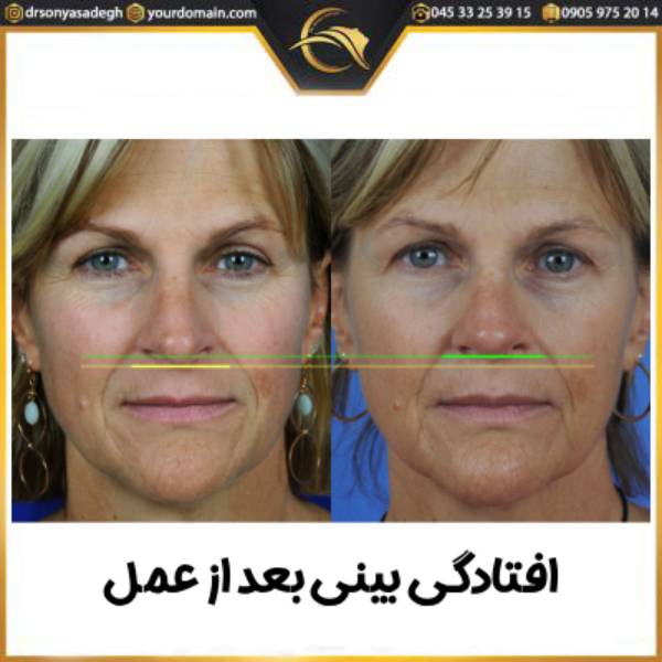 افتادگی بینی بعد از جراحی بینی