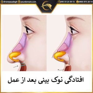 افتادگی نوک بینی بعد از عمل | دکتر سونیا صادق