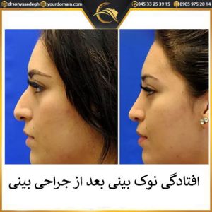 افتادگی نوک بینی بعد از عمل | دکتر سونیا صادق