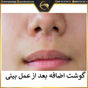 گوشت اضافه بعد از جراحی بینی | دکتر سونیا صادق 