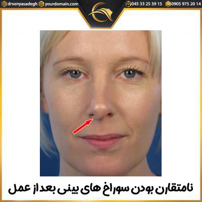 نامتقارن بودن سوراخ های بینی بعد از عمل