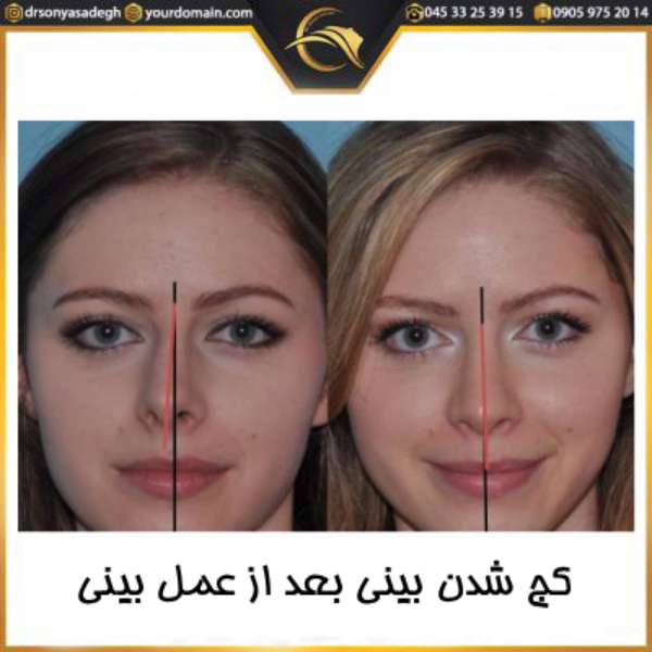کج شدن بینی بعد از عمل بینی