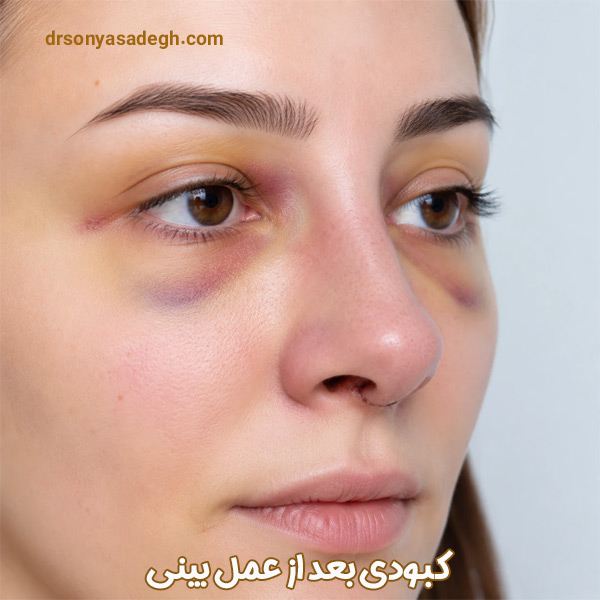 کبودی بعد از عمل بینی - دکتر صادق