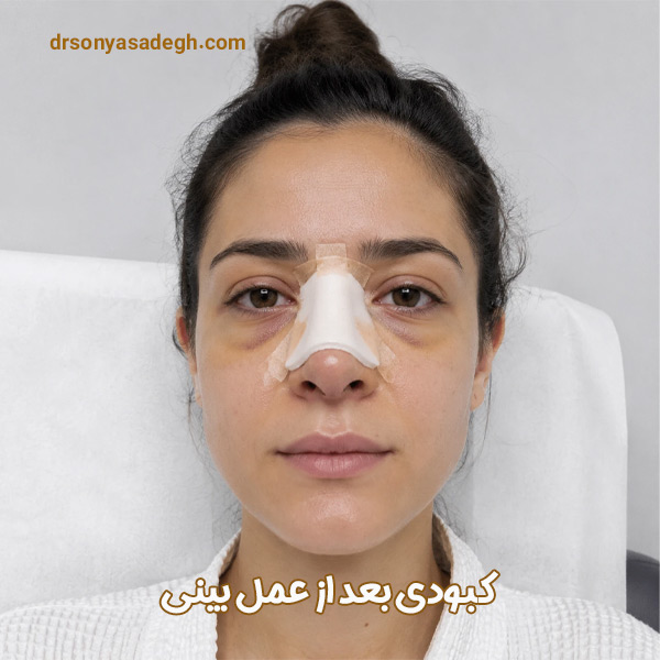 کبودی بعد از عمل بینی - دکتر صادق