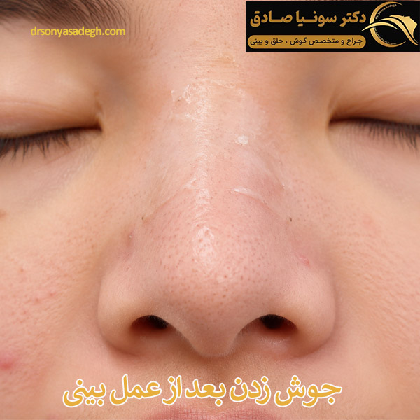 جوش زدن بعد از عمل بینی - دکتر صادق