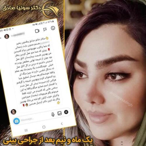جراحی-بینی-12