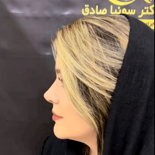 جراحی-بینی-59